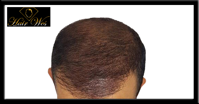 micropigmentation cheveux 02