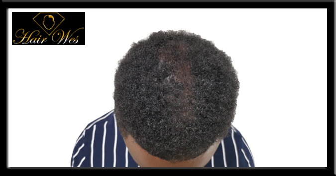 micropigmentation cheveux 06
